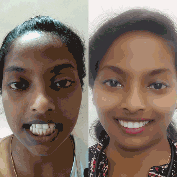 How To Fix Teeth Gap Treatment With Invisible Braces Toothsi   Pre Post 978222d173 